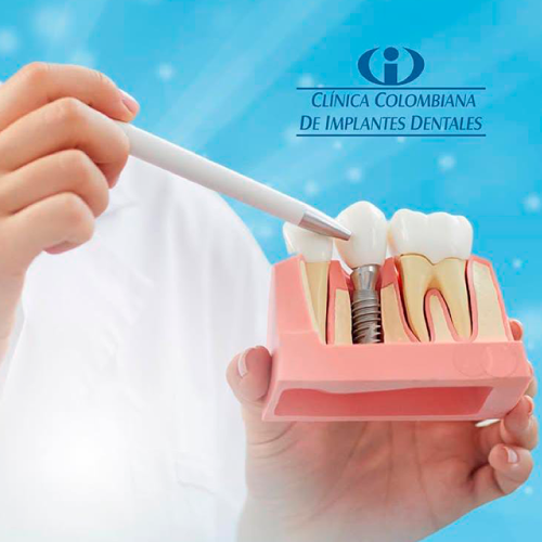 Imagen de Implantes Dentales