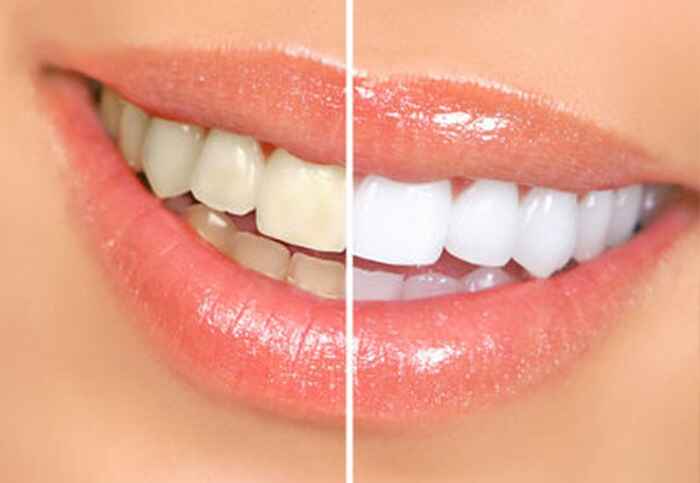 Diseno de Sonrisa